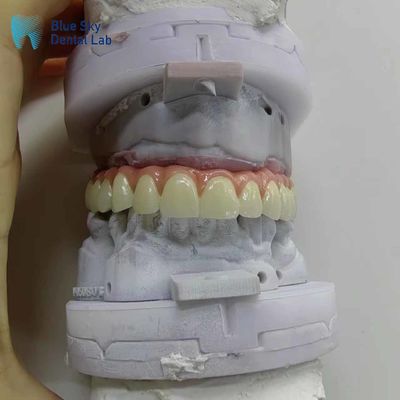 Buy Nature Artificial Dental Implant Cases Customized Full Mouth Implant Case online manufacture