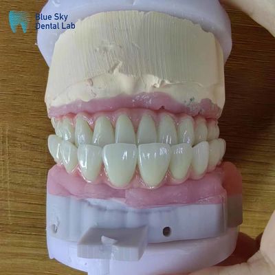 Buy Artificial Full Arch Dental Implants Operation Cases For Surgical Procedures online manufacture
