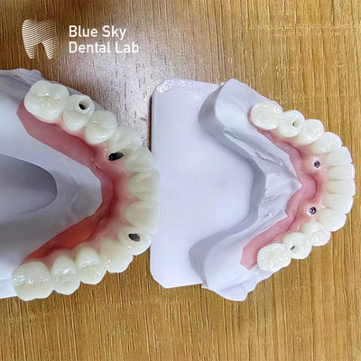 Buy Dental Multi Implant Cases Customized Implant Procedure Cases online manufacture