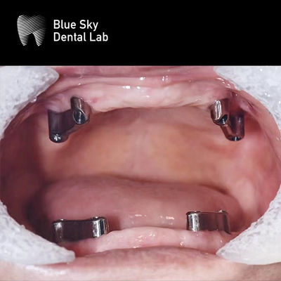 Buy Resin Teeth Dental Titanium Bar Removable Blue Sky Implant System online manufacture