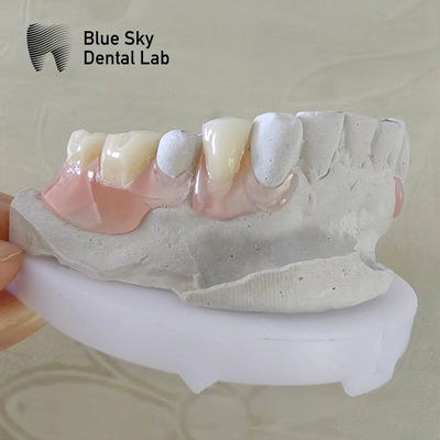 Buy Natural Smile Dental Valplast Dentures Flexi Valplast Removable Partial Denture online manufacture