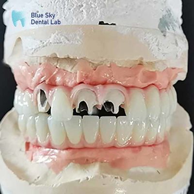 Titanium Malo Bridge Implant Bridge Without Multi Unit Abutment Cementable