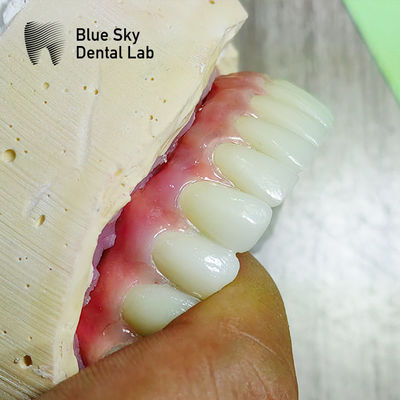 Nature Surface Universal Compatible Multiple Choices Implant operation cases for Steam Sterilization