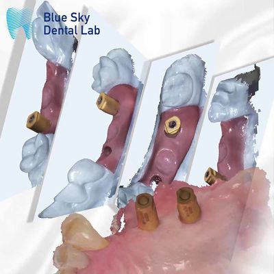 Scan Body  All In One Dental Healing Capsule Blue Sky Implant System