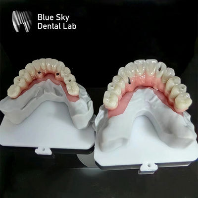 Blue Sky Implant Full Arch Implant Cases Nature Implantation Cases