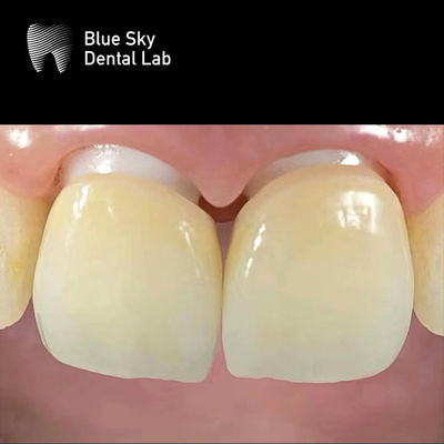 Layered Zirconia Implant Crown Zirconia Abutment Biocompatible