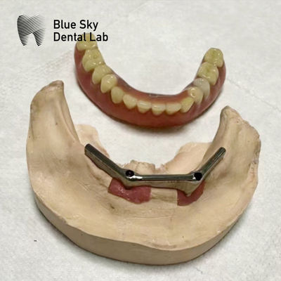 Implant Overdenture Titanium Bar Dental Implant with removable denture