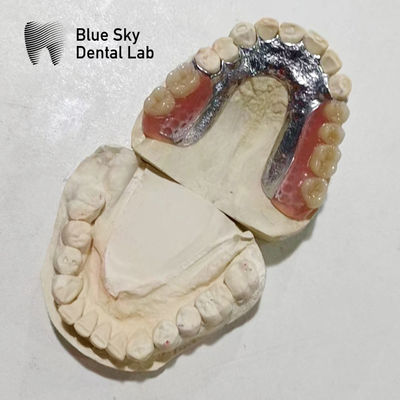 Adjustable Denture Metal Framework Resin Teeth Rpd Metal Framework