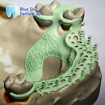 Removable Denture Rpd Framework Design Metal Partial Denture Framework Design
