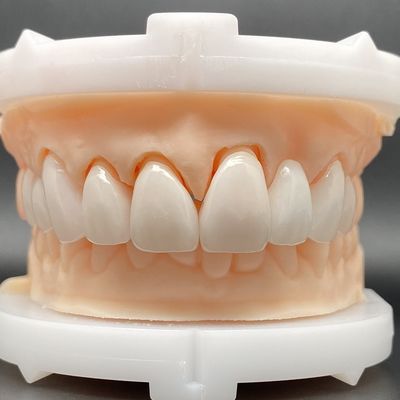 EMax Veneer Cases Passive Fitting In Multiple Colors MAKE Beautiful Smile With Minimal Tooth Preparation